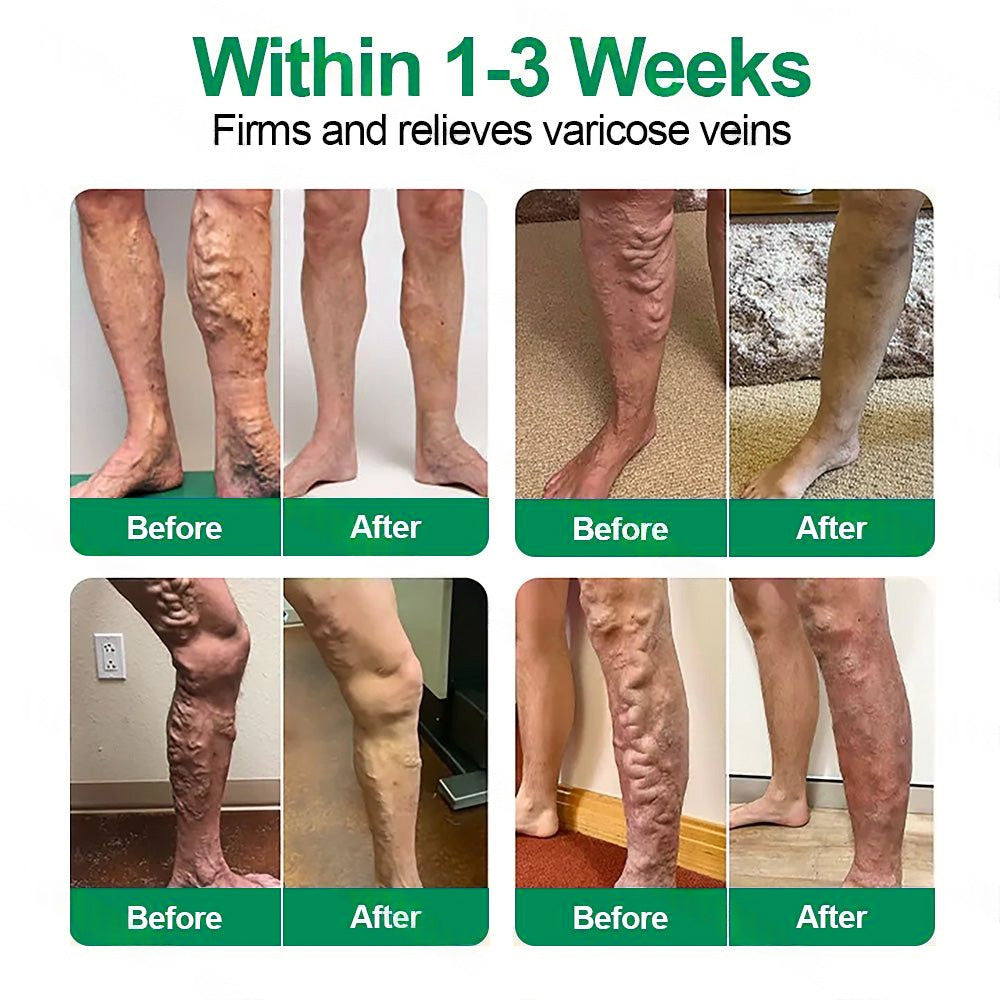 [FDA-Registered & GMP Certified]| 𝙋𝙪𝙧𝙚𝙡𝙪𝙭𝙤® 🇺🇸VeinTarget Microneedle Patch⚡Instant Relief, Long-Term Results