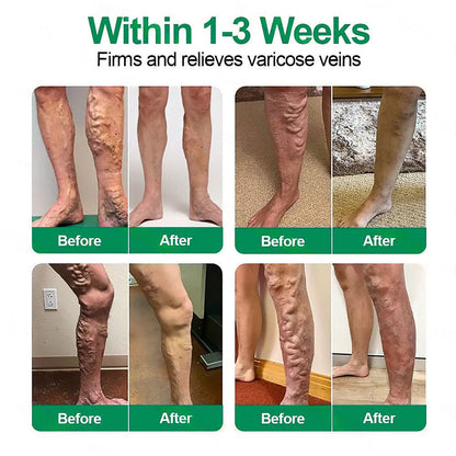 [FDA-Registered & GMP Certified]| 𝙋𝙪𝙧𝙚𝙡𝙪𝙭𝙤® 🇺🇸VeinTarget Microneedle Patch⚡Instant Relief, Long-Term Results